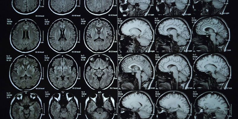 Hình ảnh chụp MRI não cho phép đánh giá và phân tích các tổn thương vùng đầu
